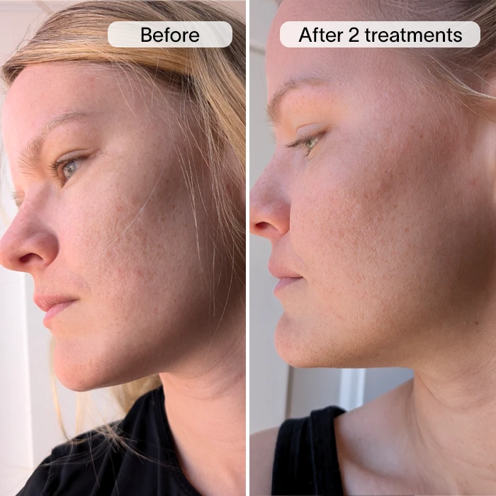Derm™ PDRN Micro Infusion System