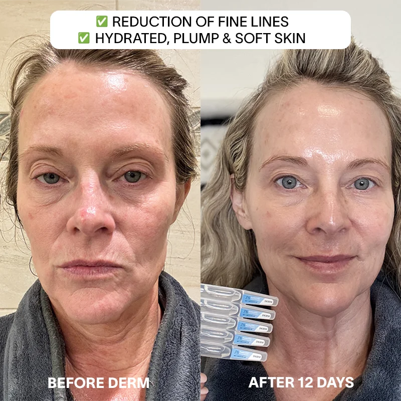 Derm™ 3% Hyaluronic Acid Serum