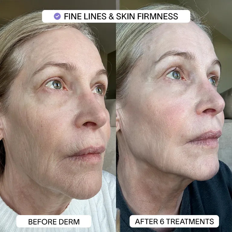 PDRN Micro Infusion Treatment