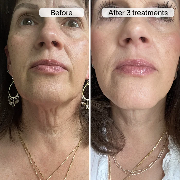 Derm™ PDRN Micro Infusion System