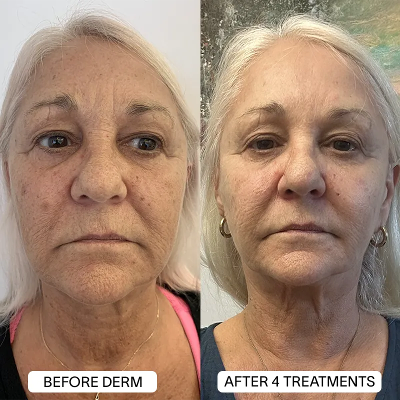 PDRN Micro Infusion Treatment
