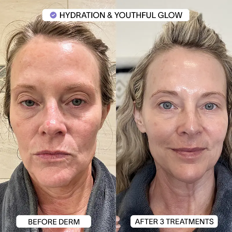 PDRN Micro Infusion Treatment