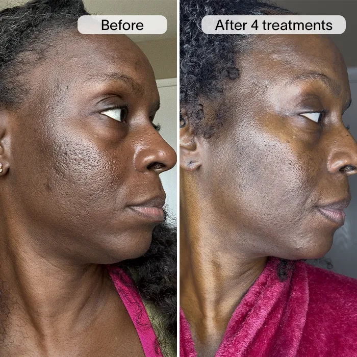 Derm™ PDRN Micro Infusion System