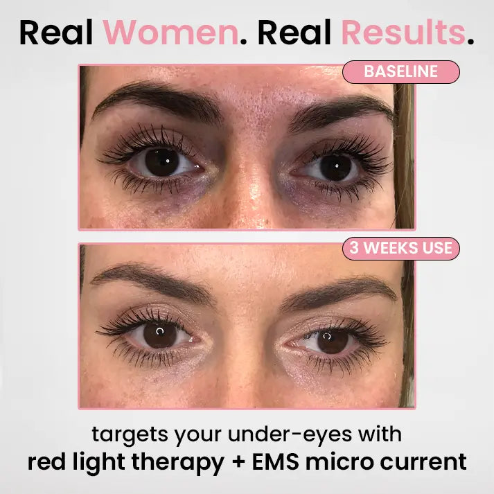 LumiEye Pro™ - Under-Eye Red Light Therapy