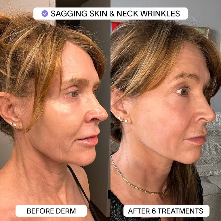 PDRN Micro Infusion Treatment