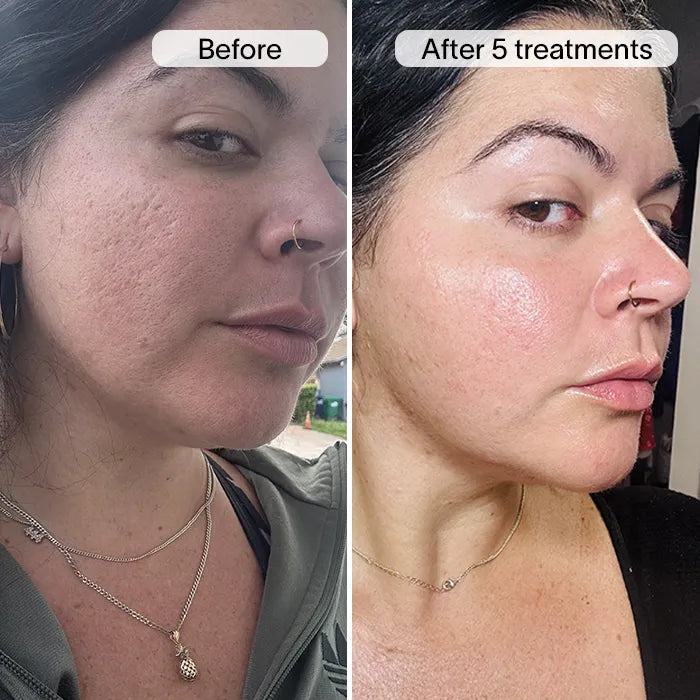 Derm™ PDRN Micro Infusion System