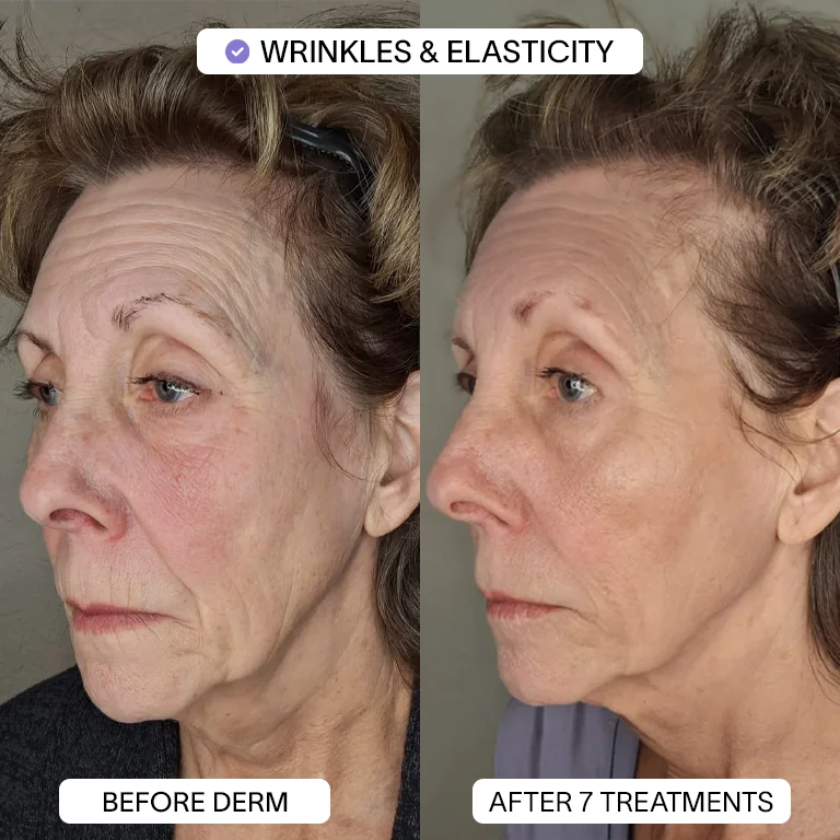 PDRN Micro Infusion Treatment
