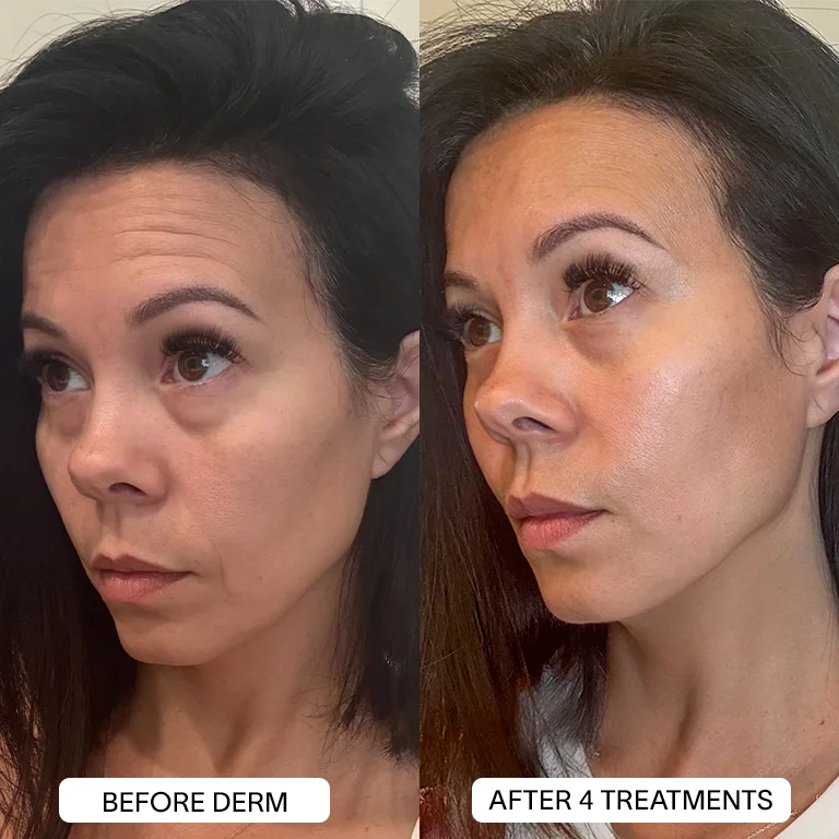 Derm™ PDRN Micro Infusion System