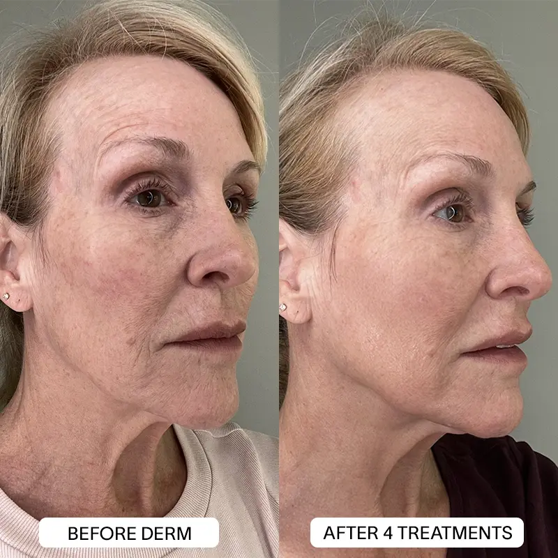 PDRN Micro Infusion Treatment